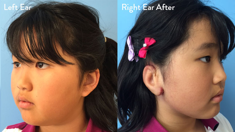 9 year old female with grade 3 microtia before and after rib cartilage graft repair 4 