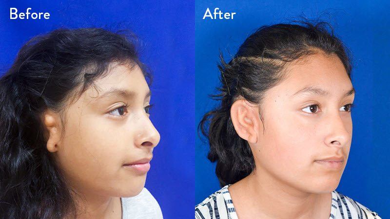 Grade 2 microtia before and after close up