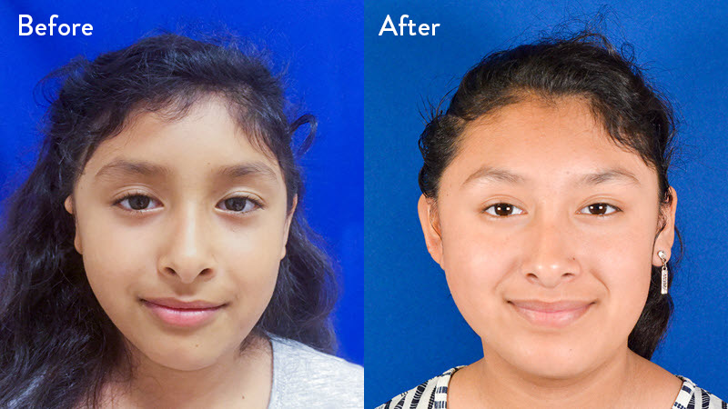 Grade 2 microtia before and after