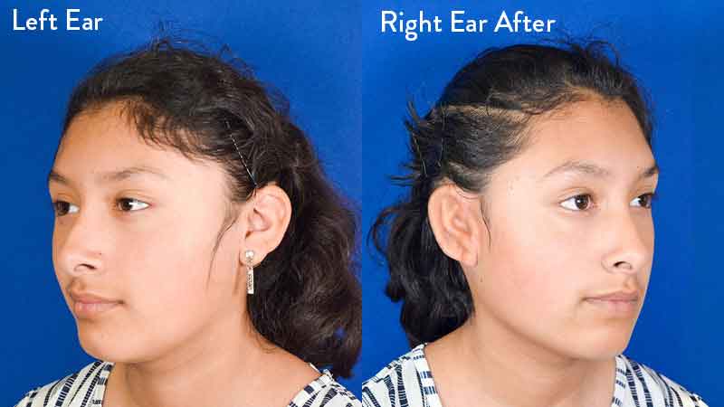 Grade 2 microtia left and right ear after