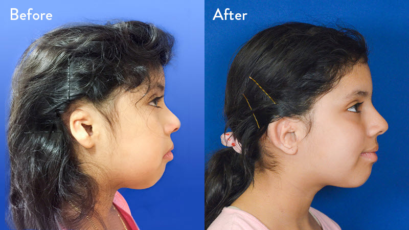 Grade 2 Microtia before and after