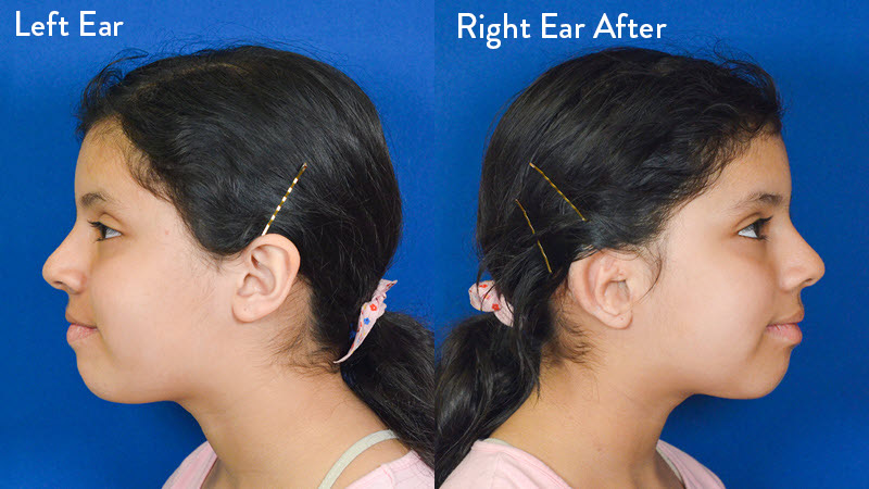 Grade 2 Microtia left and right after