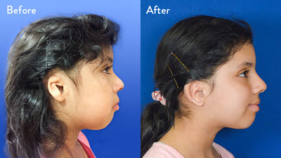 9-year-old Female with Right Grade 2 Microtia