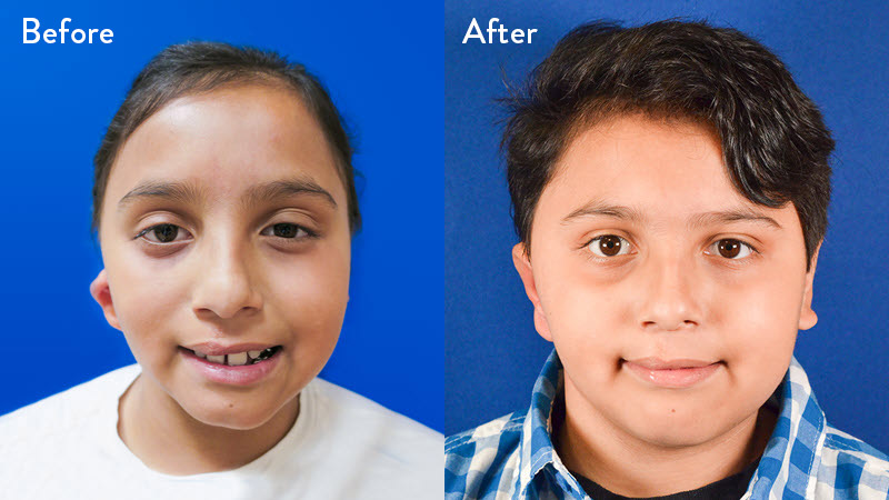 Grade 2 Microtia before and after