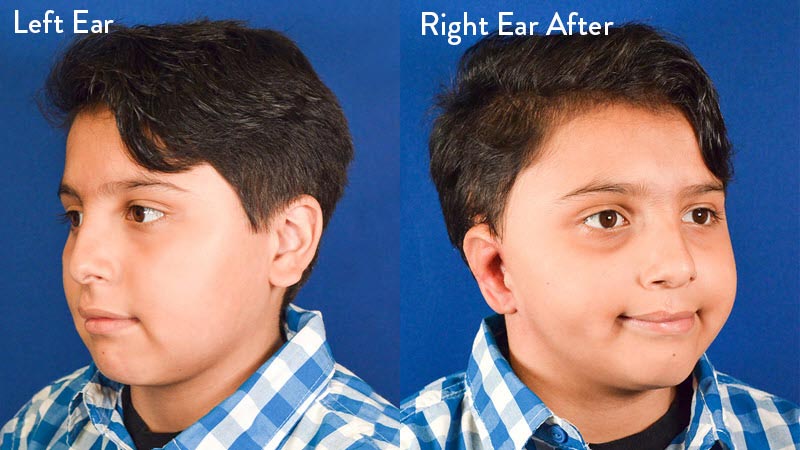 Grade 2 Microtia left and right ear after