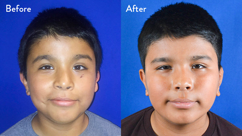 9-year-old Male with Left Grade 2-3 Microtia