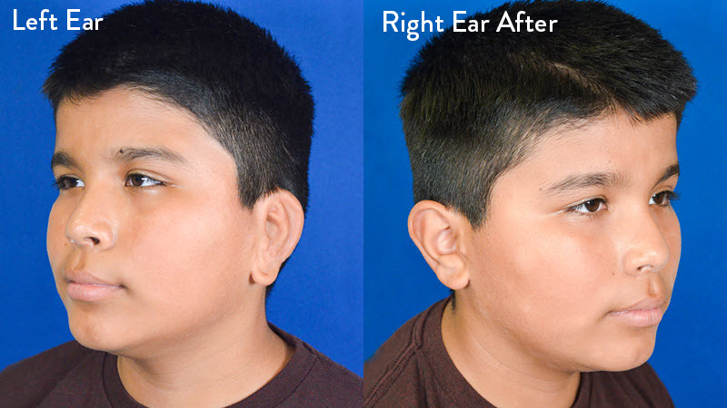 9-year-old Male with Left Grade 2-3 Microtia