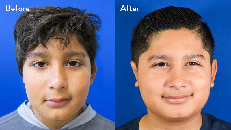 Grade 2 Microtia before and after
