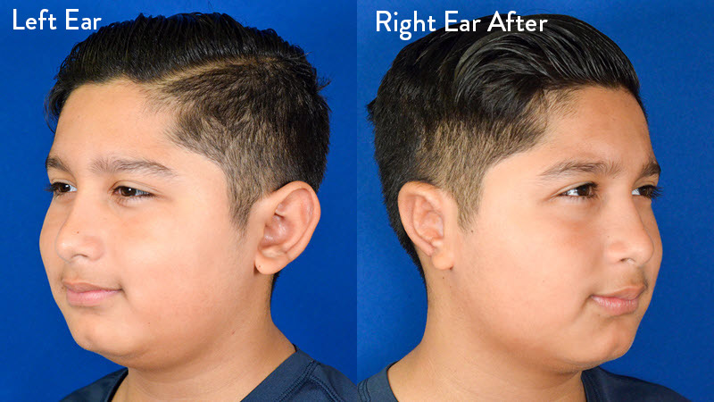 Grade 2 Microtia before and after