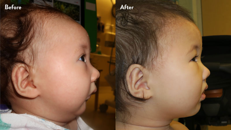 Before and after of infant with orthodontic airway plate treatment