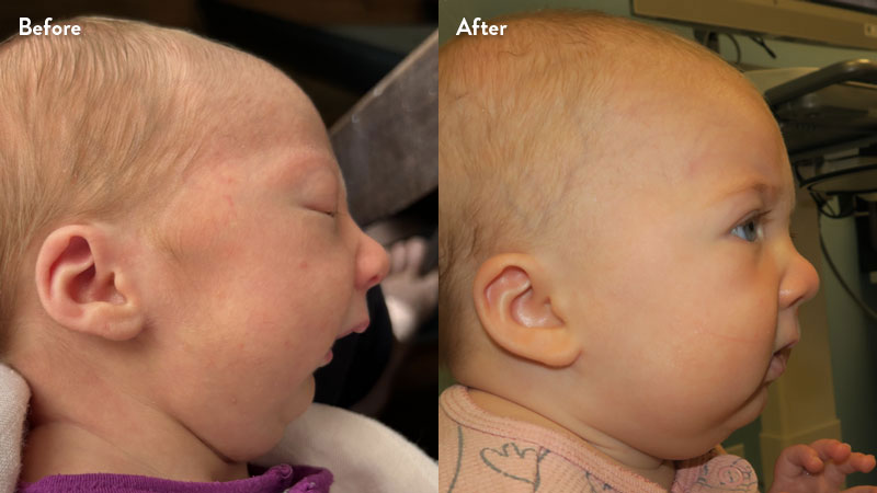 Before and after of infant with orthodontic airway plate treatment