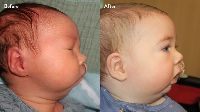 Before and after of infant with orthodontic airway plate treatment