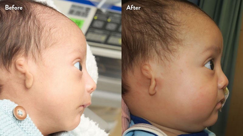 Before and after of infant with orthodontic airway plate treatment