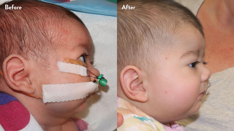 Before and after of infant with orthodontic airway plate treatment