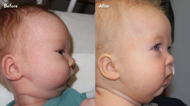 Before and after of infant with orthodontic airway plate treatment