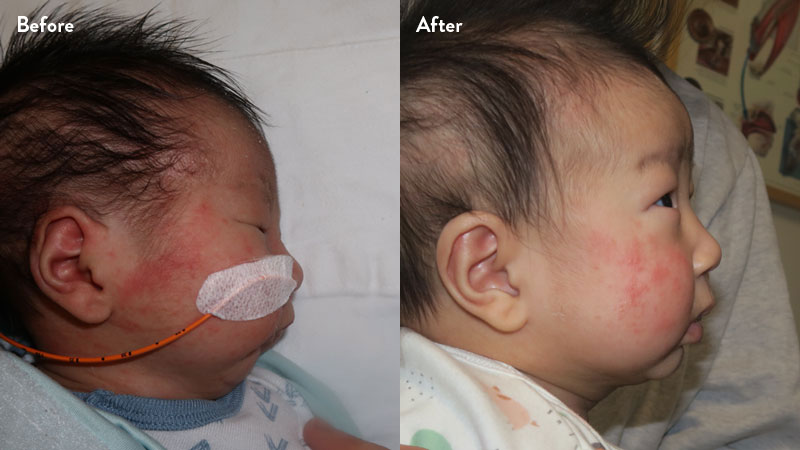 Before and after of infant with orthodontic airway plate treatment
