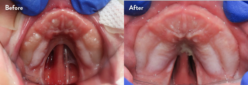 Before and after of infant with orthodontic airway plate treatment