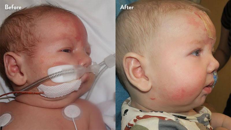 Before and after of infant with orthodontic airway plate treatment
