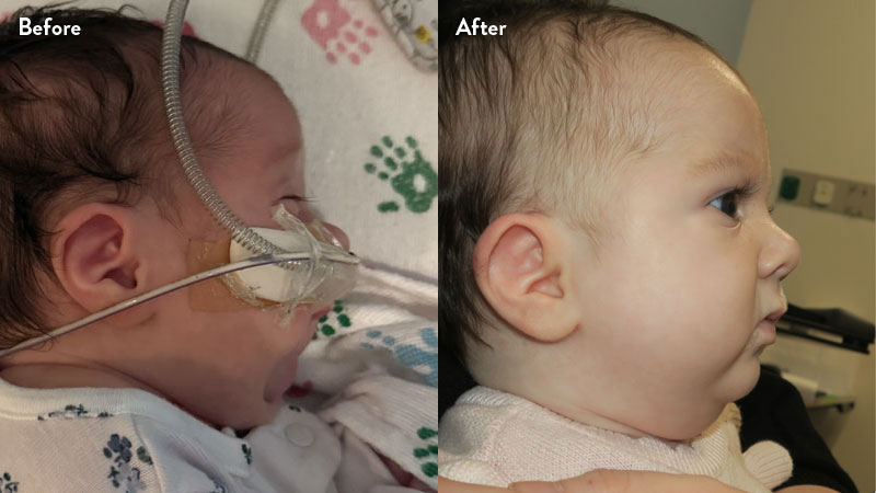 Before and after of infant with orthodontic airway plate treatment