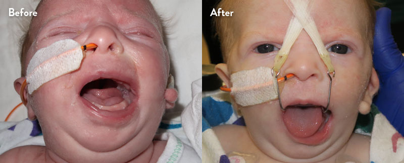 Before and after of infant with orthodontic airway plate treatment