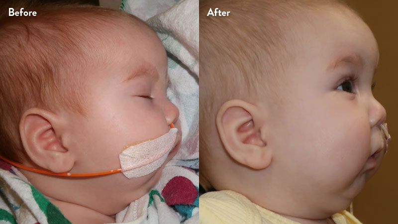 Before and after of infant with orthodontic airway plate treatment