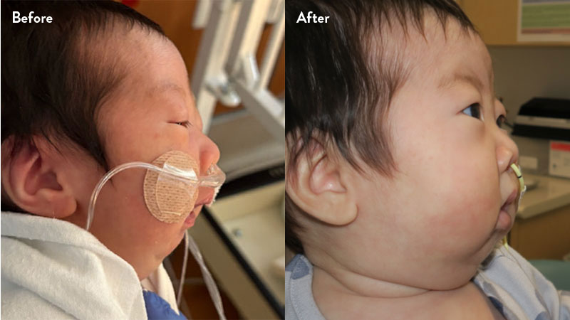 Before and after of infant with orthodontic airway plate treatment