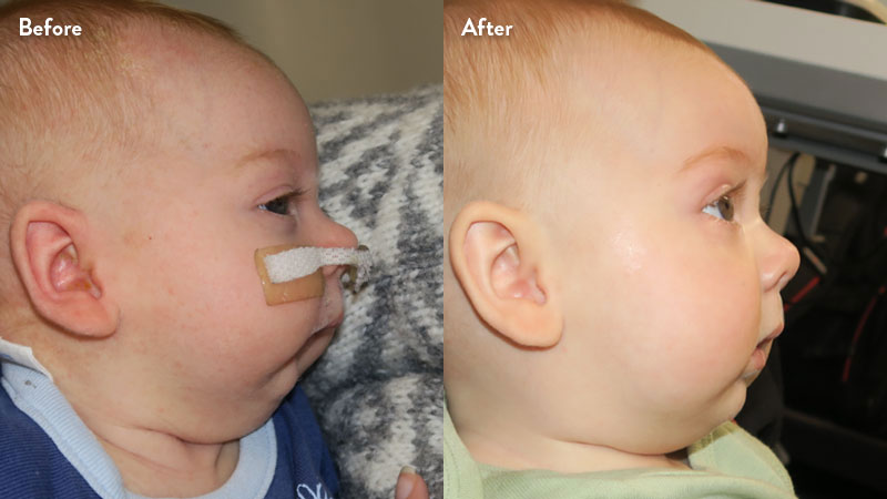 Before and after of infant with orthodontic airway plate treatment
