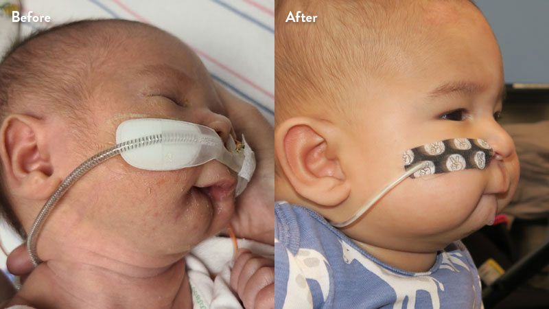 Before and after of infant with orthodontic airway plate treatment